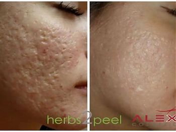 Пилинги Herbs2Peel ДО И ПОСЛЕ