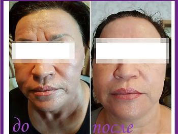 Пилинги Herbs2Peel ДО И ПОСЛЕ