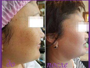 Пилинги Herbs2Peel ДО И ПОСЛЕ