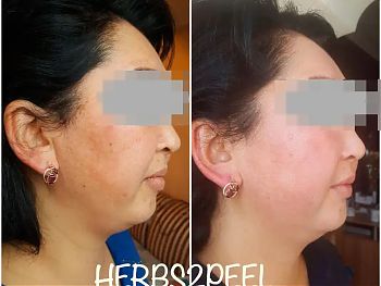 Пилинги Herbs2Peel ДО И ПОСЛЕ