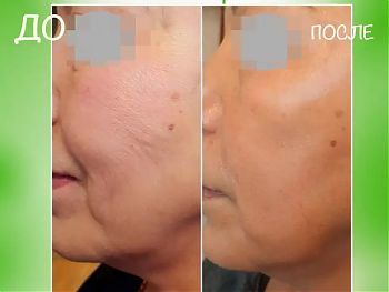 Пилинги Herbs2Peel ДО И ПОСЛЕ