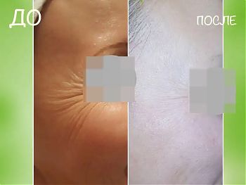 Пилинги Herbs2Peel ДО И ПОСЛЕ