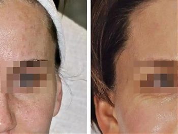 Пилинги Herbs2Peel ДО И ПОСЛЕ