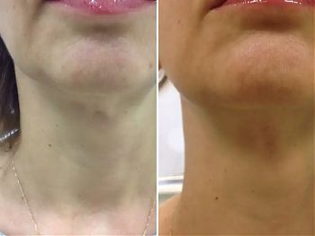 Пилинги Herbs2Peel ДО И ПОСЛЕ