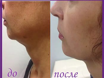 Пилинги Herbs2Peel ДО И ПОСЛЕ