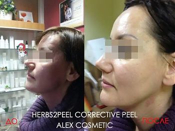 Пилинги Herbs2Peel ДО И ПОСЛЕ