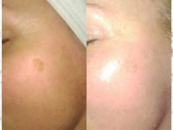 Пилинги Herbs2Peel ДО И ПОСЛЕ