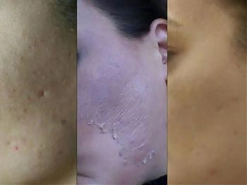 Пилинги Herbs2Peel ДО И ПОСЛЕ
