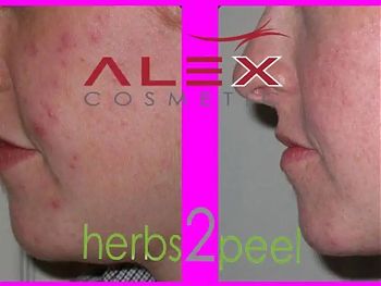 Пилинги Herbs2Peel ДО И ПОСЛЕ