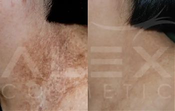 Пилинги Herbs2Peel ДО И ПОСЛЕ