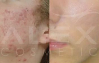 Пилинги Herbs2Peel ДО И ПОСЛЕ
