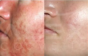 Пилинги Herbs2Peel ДО И ПОСЛЕ