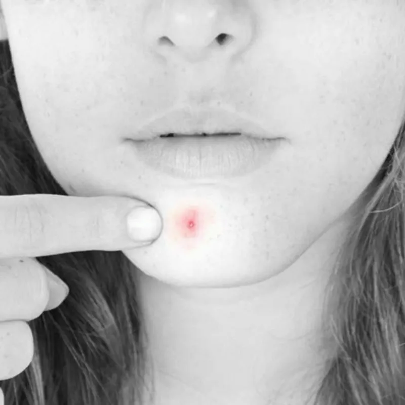 Средство от прыщей на лице Stop on Spot 10 мл